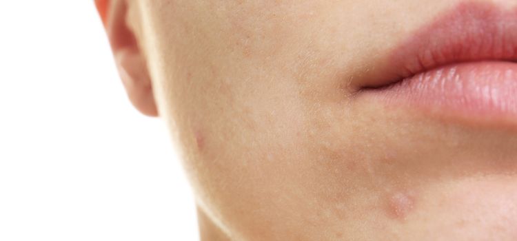 Arctiszt&iacute;t&aacute;s eredm&eacute;nye a selymes fiatalos eg&eacute;szs&eacute;ges bőr