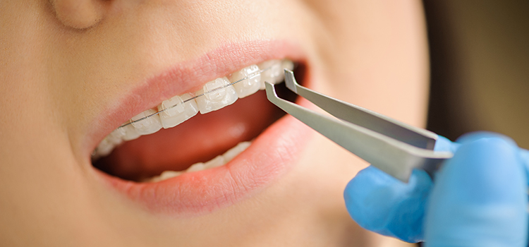 damon fogszab&aacute;lyoz&oacute;