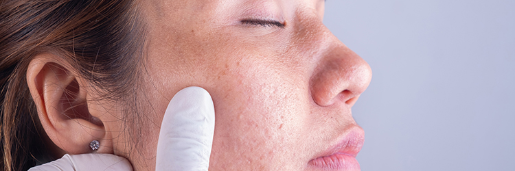 mezoter&aacute;pi&aacute;s kezel&eacute;s a fiatalos bőr&eacute;rt