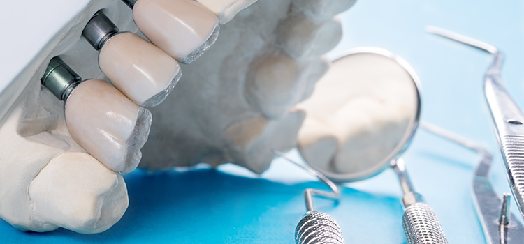 fogpótlás Budapest ár