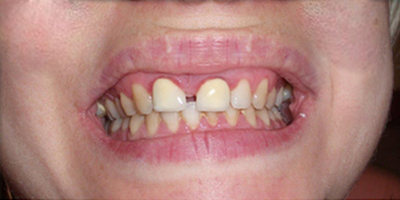 személyreszabott mosoly mosolytervezés előtt