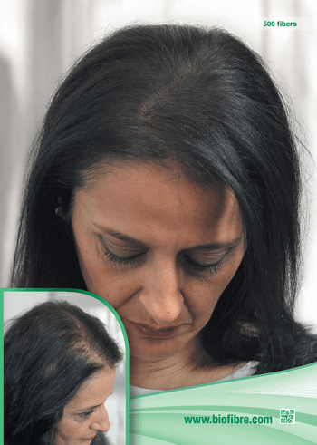 Hajbeültetés a magabiztos megjelenés érdekében