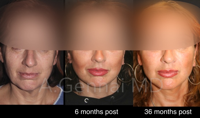 előtte utána ráncfeltöltés arcfeltöltés saját zsírral vélemények