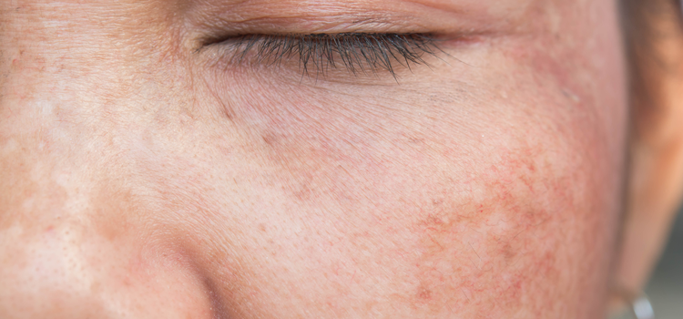 Mindig &oacute;vjuk a bőr&uuml;nket az erős napsug&aacute;rz&aacute;st&oacute;l