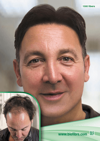 hajbeültetés az azonnali látványos eredményért