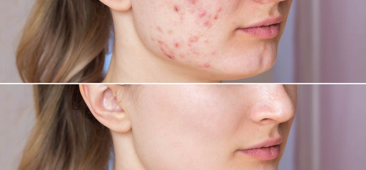 pattan&aacute;s ellen