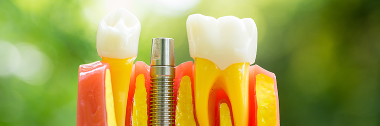 fogp&oacute;tl&aacute;s &aacute;r