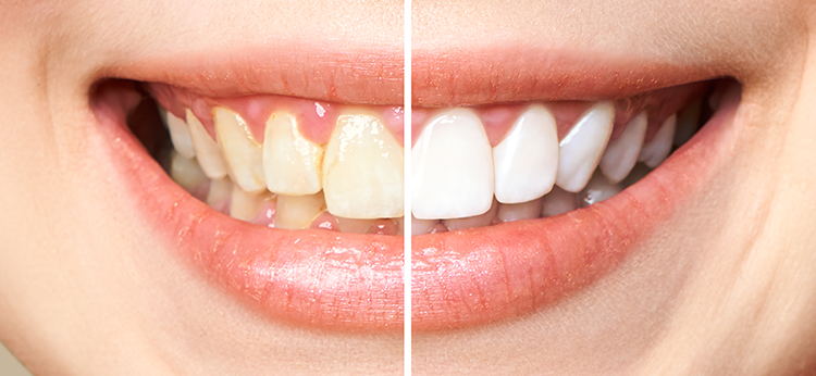 fogfeh&eacute;r&iacute;t&eacute;s szolg&aacute;ltat&aacute;s az IdealMedn&eacute;l