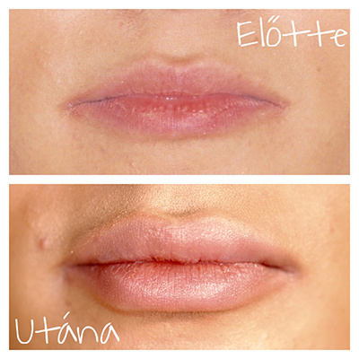 szájfeltöltés Budapest szívében hyalurnonsavval