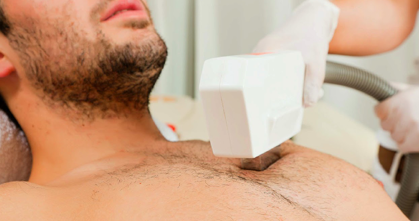 Férfi szőrtelenítés lézerrel