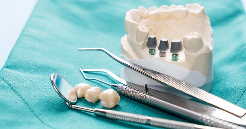 Fog implantátum, a tökéletes hosszútávú megoldás