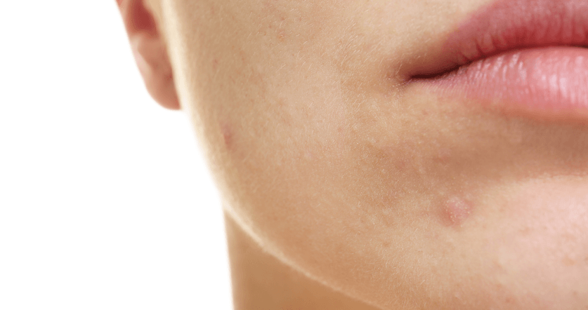 Számolj le végleg a bőrproblémákkal!