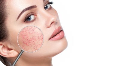 Rosacea kezelés – hogyan lehet az arc ereinek kitágulását, gyulladását enyhíteni?