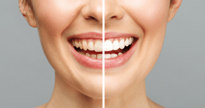 Ajándékozz hófehér, gyönyörű mosolyt idén Karácsonyra!