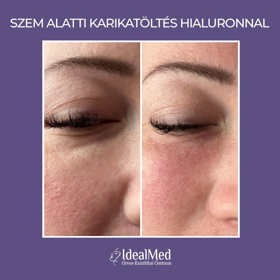 Előtte-Utána Hyaluronsavas arctöltés 02